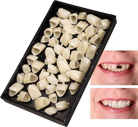 what are fake front teeth called